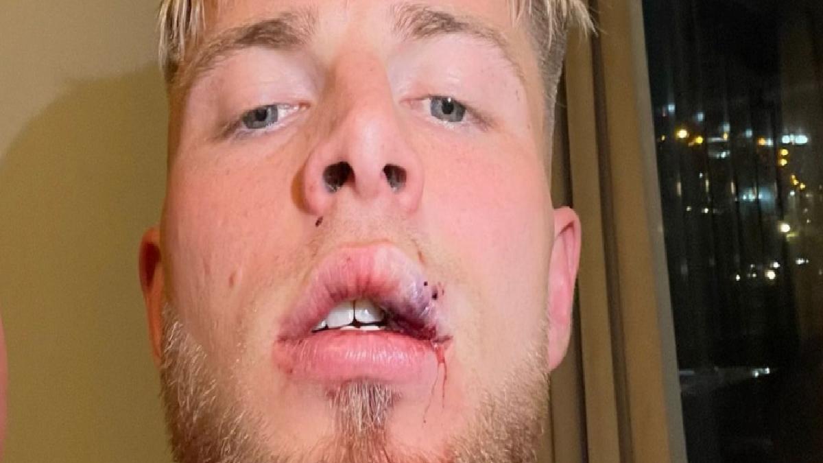 Samsunspor’da Rick van Drongelen’in dudağına dikiş atıldı