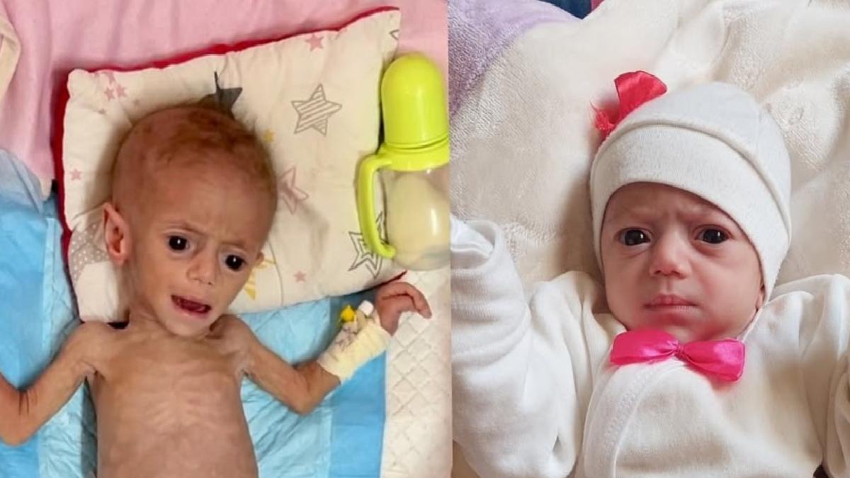 Gazze’de beş aylık Suvar Aşur, yetersiz beslenme yüzünden ölümle burun buruna
