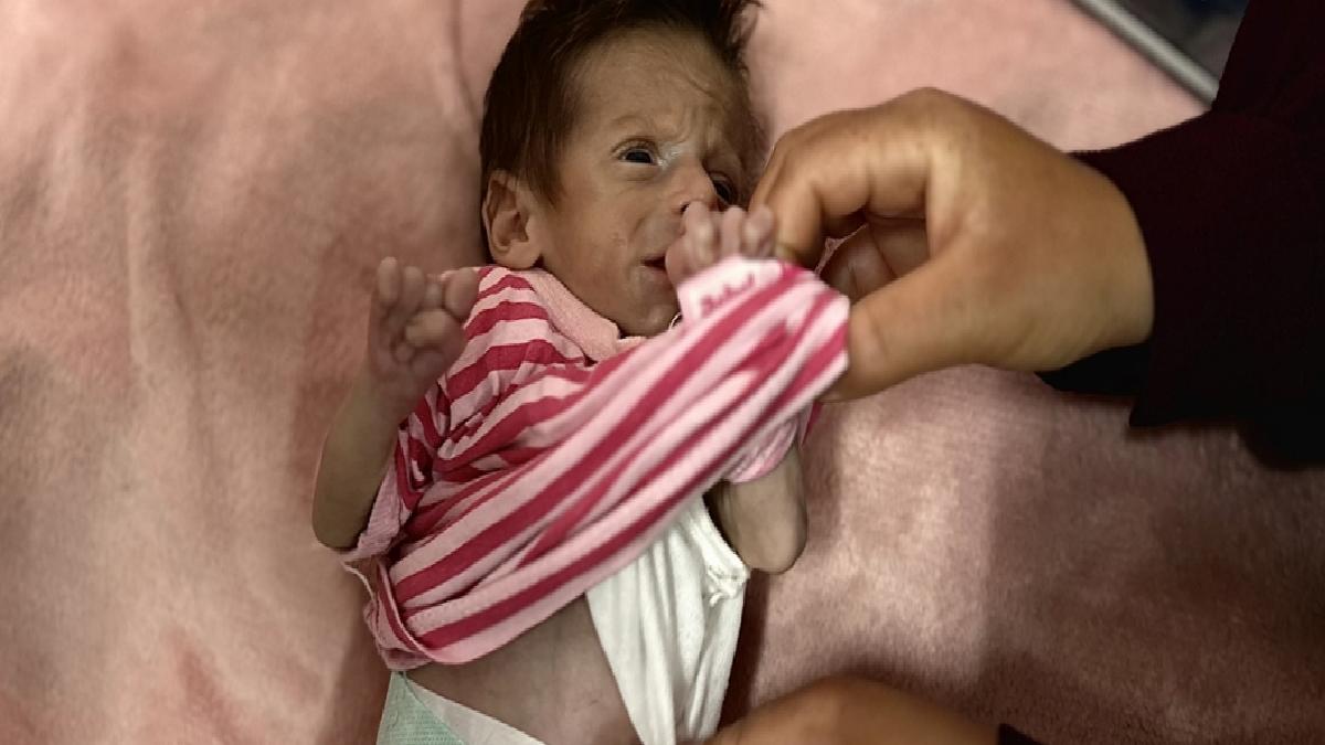 Gazze’de bir bebek daha açlık yüzünden can vermek üzere