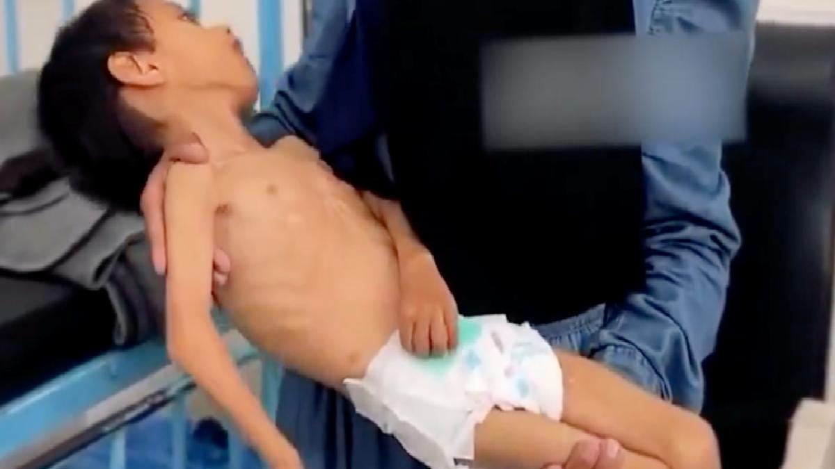 Gazze’de bir çocuk daha yetersiz beslenme nedeniyle yaşam savaşı veriyor