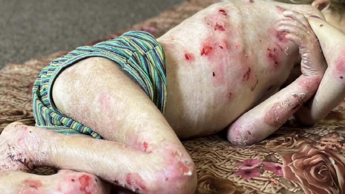 Gazze’de çocuklar hem açlık hem de hastalıkla mücadele ediyor