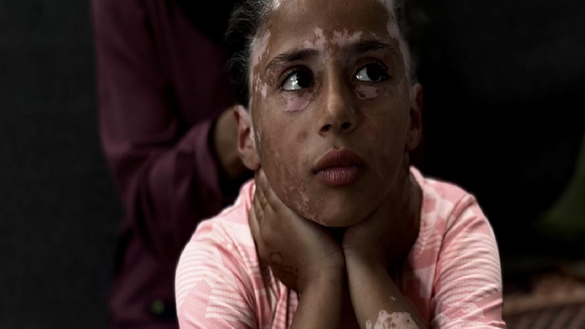 Gazzeli Lana, İsrail korkusu yüzünden vitiligo hastalığına yakalandı